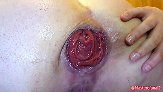 BBW extreme anal insertions with rosebud and cervix prolapse
