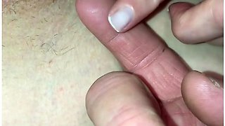 Doctor Pimple Popr Pussy Edition: Tag Teamed Her Ingrown Hair Cyst & Something Else